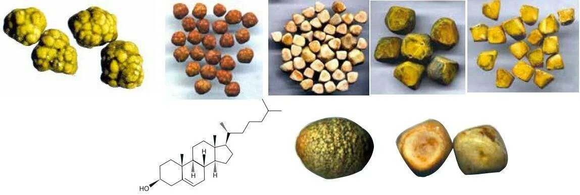 Камень холестерина. Желчекаменная болезнь холестериновые камни. ЖКБ камни холестериновые. Типы камней при желчнокаменной болезни. Камни в желчном пузыре (холелитиаз)..