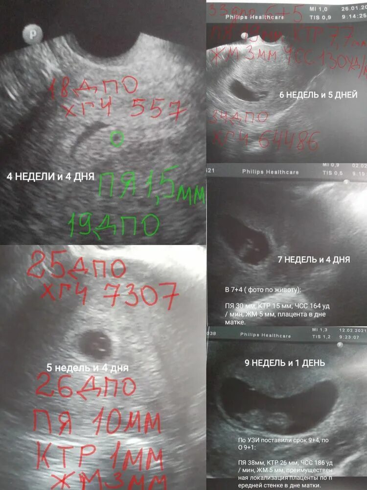 Плодное яйцо 1 5. Узи плодное яйцо 5 недель.