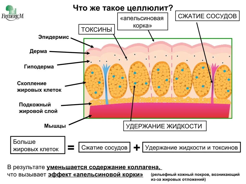 Почему появляется жир. Подкожно-жировая клетчатка целлюлит. Стадии целлюлита схема. Строение кожи целлюлит. Целлюлит структура кожи.