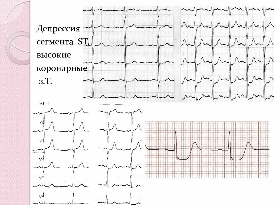 Эпизод депрессии st. Корытообразный сегмент St на ЭКГ. Депрессия St на ЭКГ В v5 v6. Окс с депрессией St на ЭКГ. Корытообразный сегмент St на ЭКГ причины.