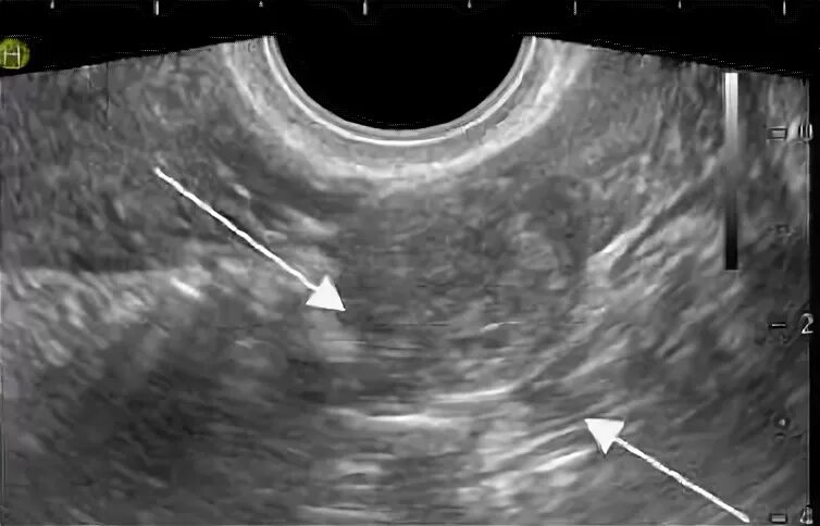 Внематочная Трубная беременность УЗИ. УЗИ на 4 неделе внематочная бер. Внематочная беременность на снимках УЗИ. УЗИ внематочной беременности 4 недели.
