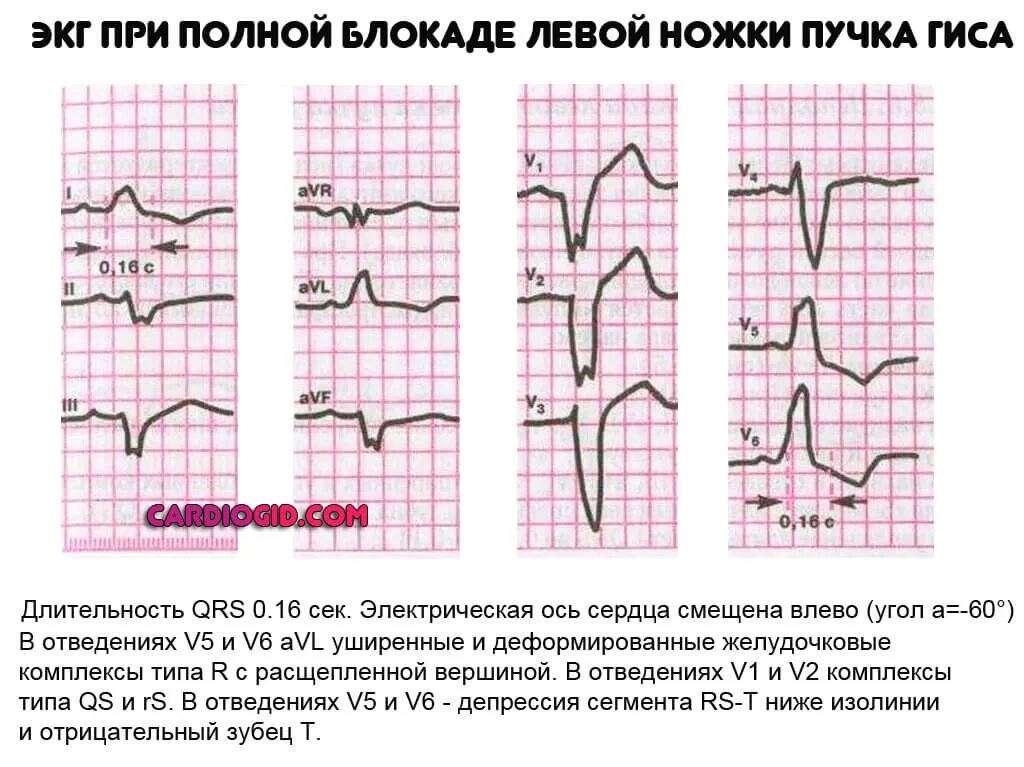 Что значит полная блокада. Полная блокада левой ножки пучка Гиса на ЭКГ. Блокада ЛНПГ на ЭКГ. Отрицательный зубец р после QRS комплекса. ЭКГ критерии блокады левой ножки пучка Гиса.