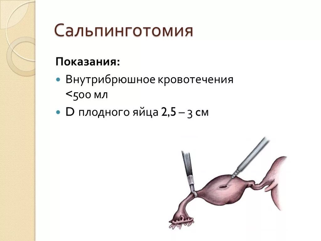 Острый гинекологический живот. Внематочная беременность сальпинготомия. Сальпинготомия при внематочной. Сальпинготомия и сальпингэктомия. Сальпинготомия показания.