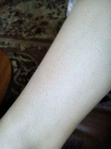 Лентиго, хлоазма, веснушки. Почему на ногах остаются следы. Отпечатки от резинок носков. Отпечатки от носков на ногах. Точки на ногах после бритья.