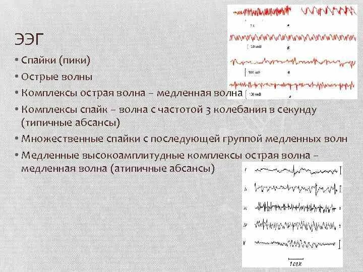 Спайк на ээг. Комплекс острая волна медленная волна на ЭЭГ. ЭЭГ спайки и острые волны. Острые волны на ЭЭГ.