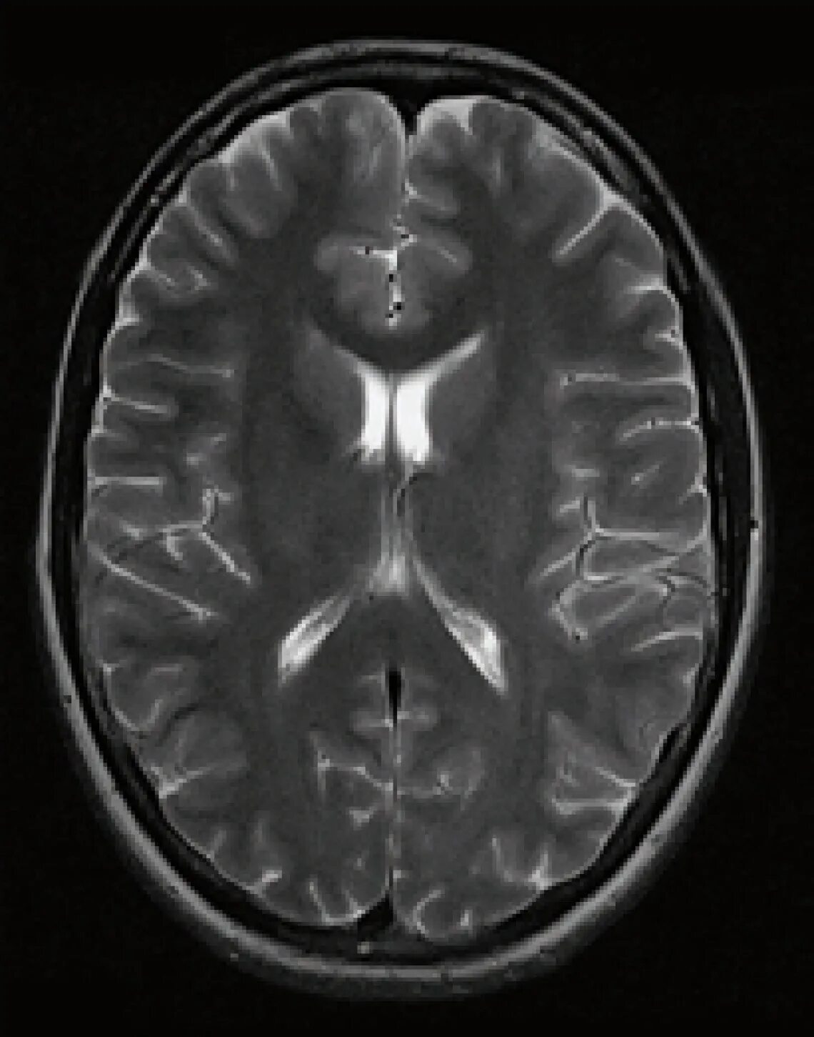 Патологии на мрт. Снимок мрт головного мозга в норме. Мрт снимки мозга норма. Компьютерная томография головного мозга норма. Снимки мрт головного мозга норма.