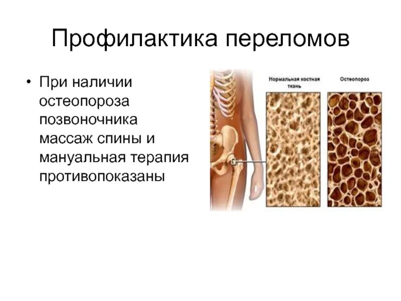 Остеопороз. Первичная профилактика остеопороза. Комплекс остеопороз. Признаки остеопороза. Вторичная профилактика остеопороза план.