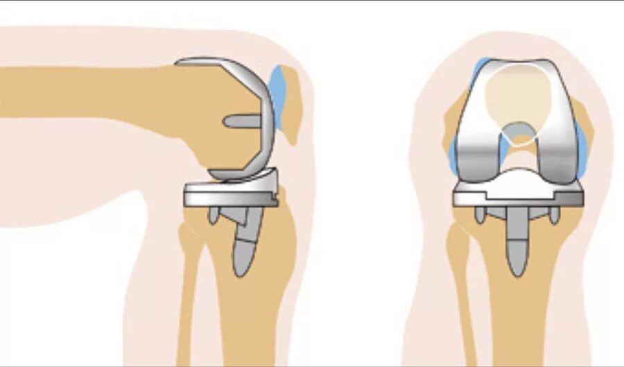 Модульный эндопротез коленного сустава цито. Заднестабилизированный эндопротез коленного сустава. Тотальное эндопротезирование коленного сустава. Рентген эндопротеза коленного сустава после эндопротезирования. Ростов замена коленного сустава