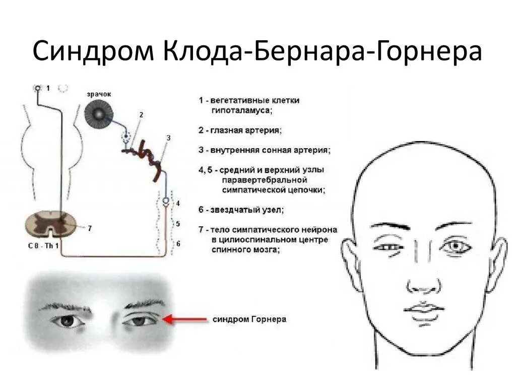 Синдром горнера это. Триада бернара горнера. симптом бернара горнера. синдром клода бернара горнера. симптомокомплекс бернара — горнера.