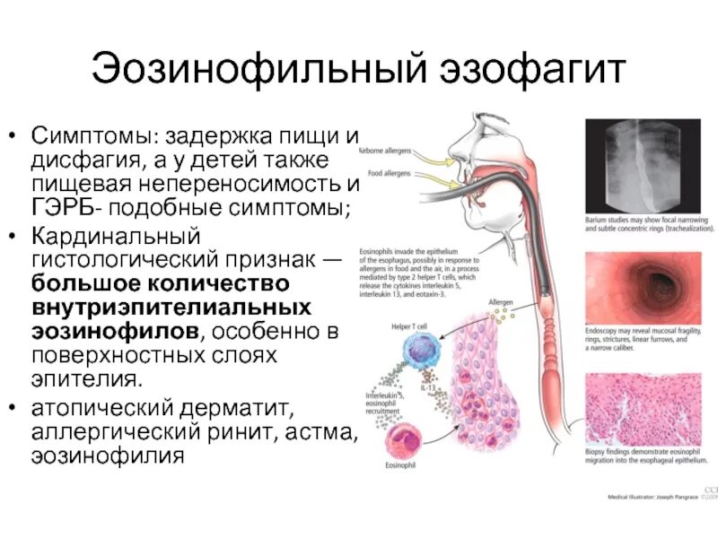 Для пищевода характерно