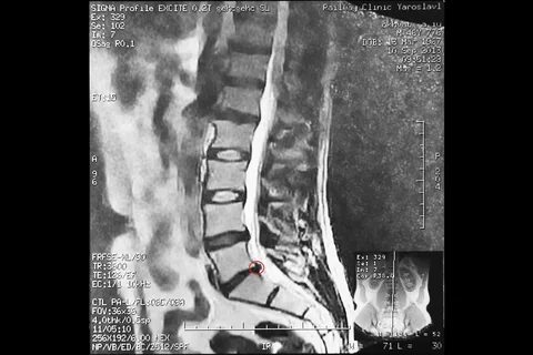 Грыжи l5 s1 отзывы