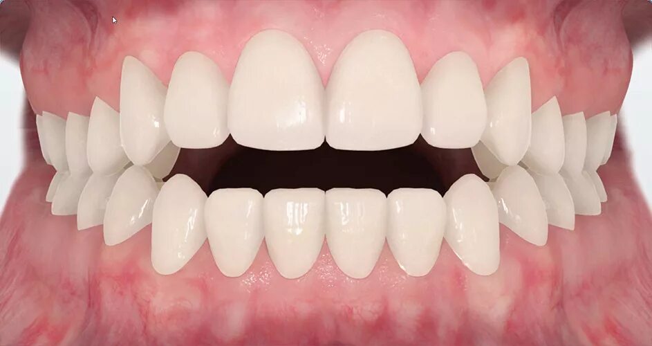 Bite forms
