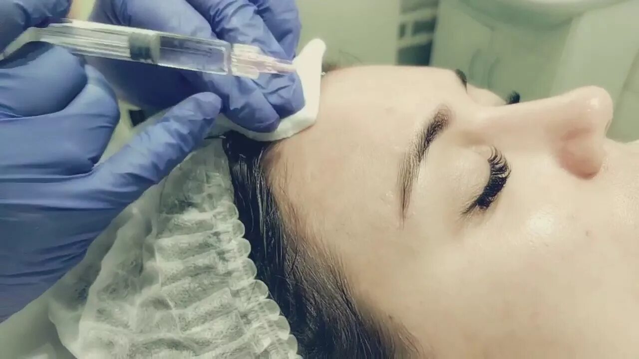 Биорепарация в канюльной методике. Техника наппаж биоревитализация. Биоревитализация новокутан. Косметология. Биоревитализация новокутан.