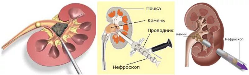 Конкремент латынь. Чрескожная пункционная лазерная нефролитотрипсия. Нефростома лоханки почки. Мочекаменная болезнь коралловидные камни. Гидронефроз почек ,нефростома.