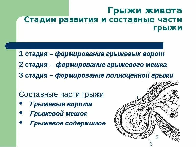 Признаки ущемленной грыжи. Пупочная грыжа классификация. Грыжевой мешок при грыже. Ущемление пупочной грыжи симптомы.