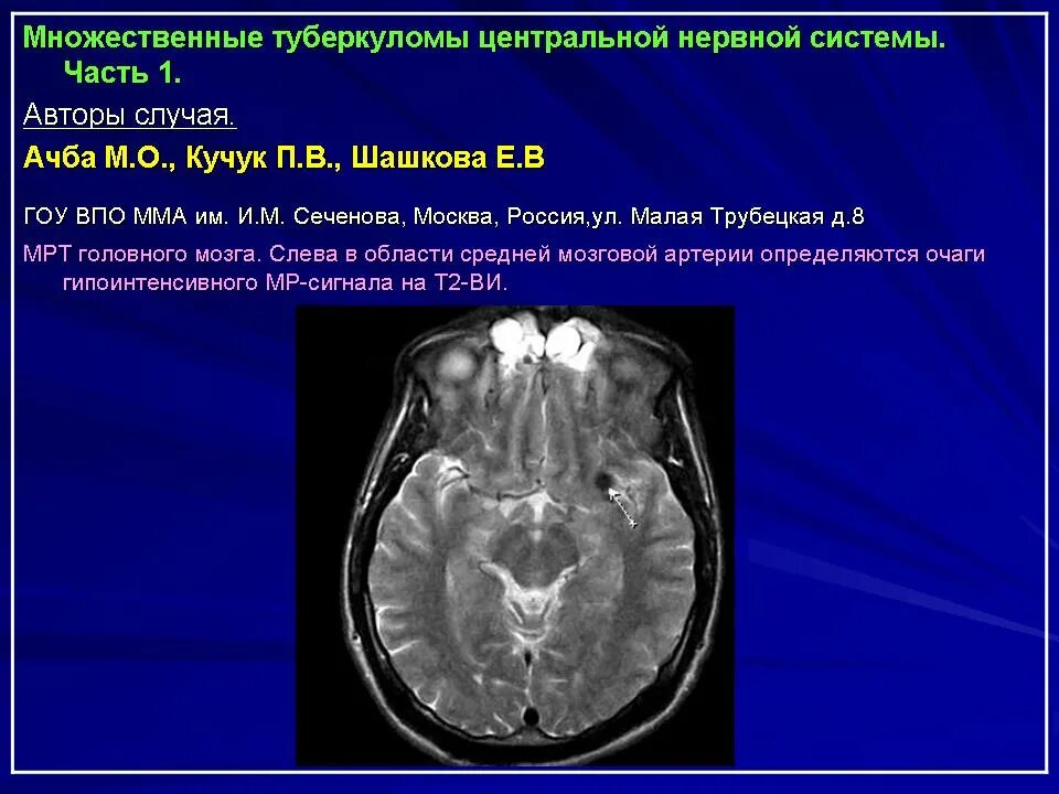 Туберкулез головного. Туберкулема головного мозга мрт. Туберкулема головного мозга на кт. Туберкулемы головной мозг мрт.