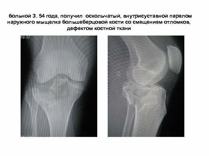 МРТ и КТ суставов. Диагностика перелома плато большеберцовой кости на снимках МР
