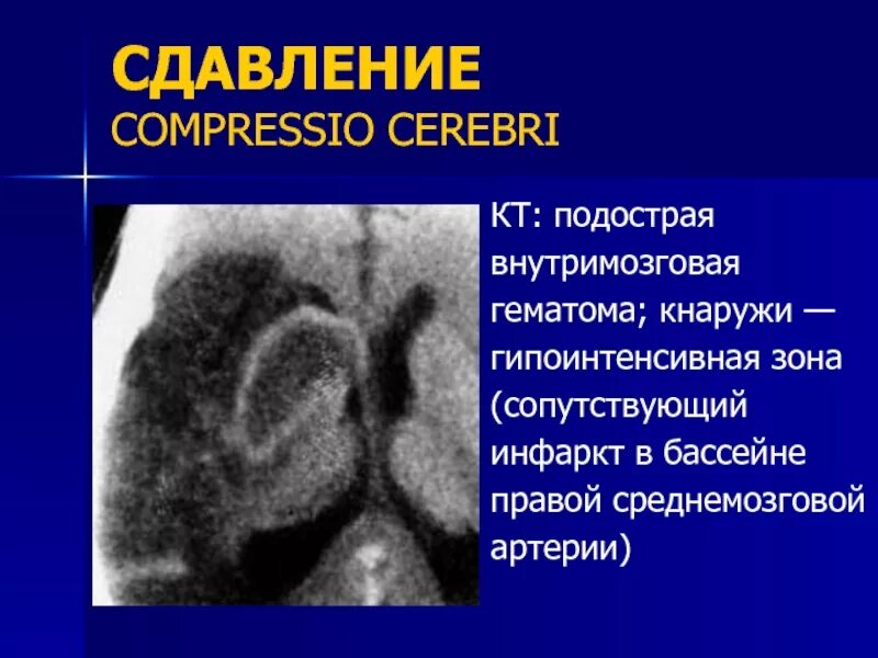 Подострая внутримозговая гематома. Подострая внутримозговая гематома на кт. Оболочечная гематома кт. Поздняя подострая внутримозговая гематома. Гематома в стадии организации