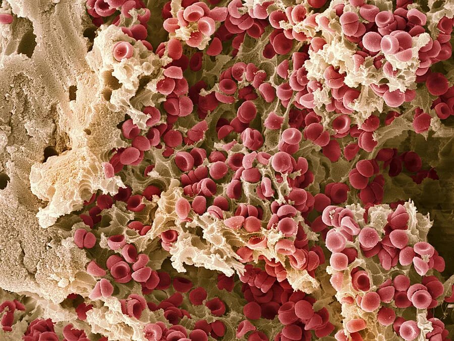 Лейкоз крови под микроскопом. Кораллы под микроскопом. Кровь под микроскопом при лейкозе. Заболевания крови под микроскопом.