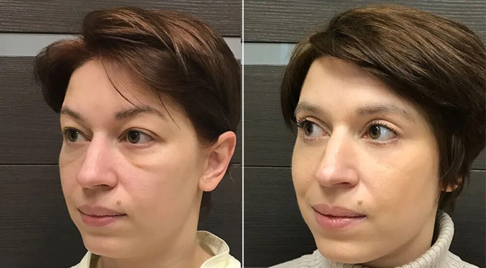 малярные мешки после блефаропластики. жиросохраняющая блефаропластика нижних век. ованесова ольга пластический хирург и блефаропластика. машкин алексей валерьевич блефаропластика вологда. блефаропластика малярных мешков.