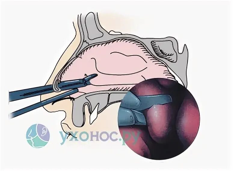 Вазотомия носовых раковин операция. Вазомоторный ринит операция. Радиоволновая вазотомия носовых раковин. Коблационная вазотомия.
