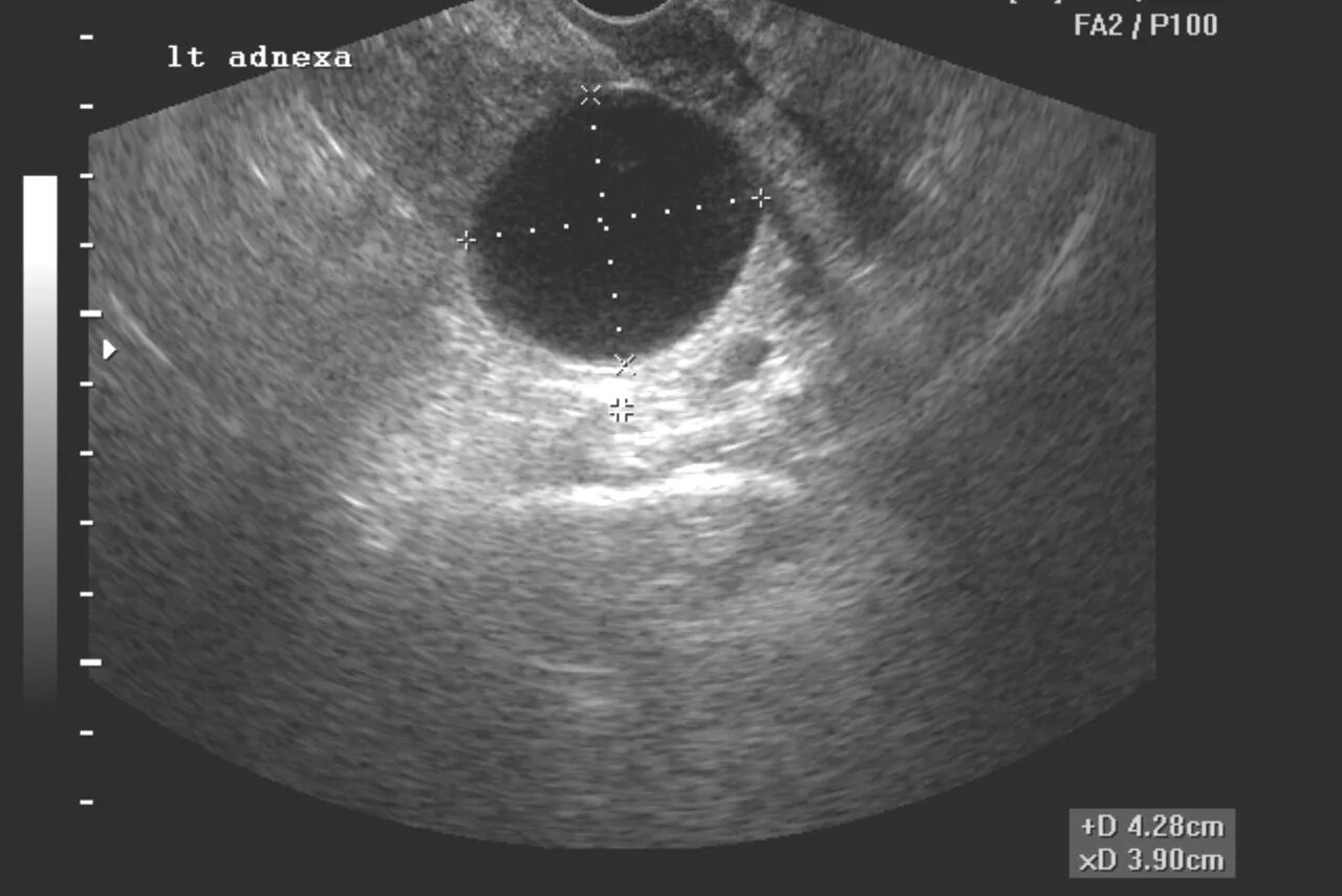 Двухкамерная киста яичника на УЗИ. Киста уретры у женщин фото. Как выглядит киста яичника на УЗИ У женщин.