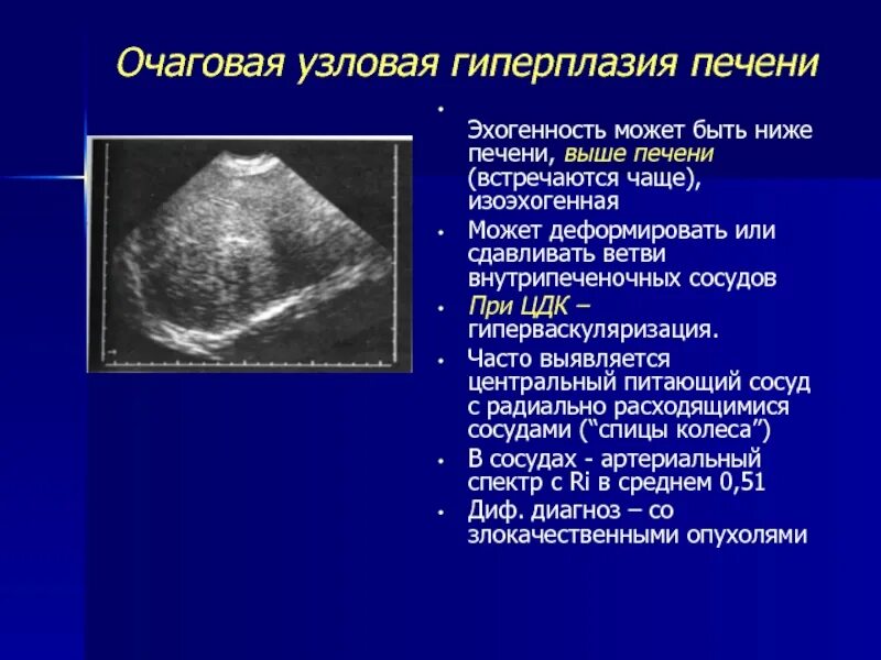 Очаговая Узловая гиперплазия печени на УЗИ. Очаговая нодулярная гиперплазия печени. Очаговое поражение печени на УЗИ. Очаговые образования в печени на УЗИ.