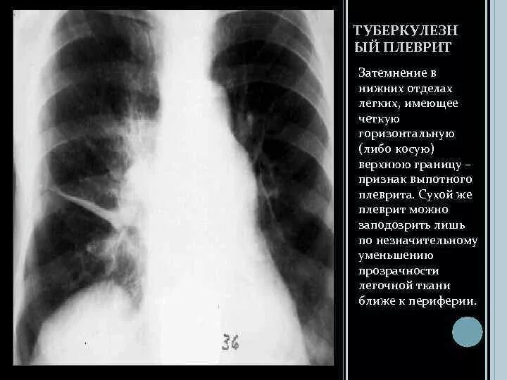 Затемнение нижней доли левого легкого. Гомогенное затемнение легких что это. Сухой плеврит рентген. Снимки плеврита легких.