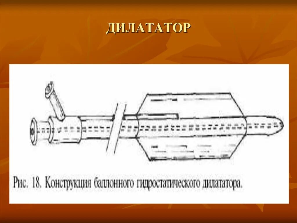 Дилататор это. Дилататор. баллон дилататор. дилататор при через вертелного.