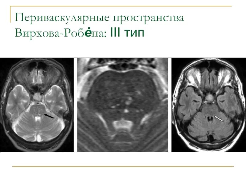 Диффузное пространство. Пространства Вирхова-Робина мрт. Пространства Робина Вирхова на кт. Периваскулярные пространства Вирхова-Робина мрт. Кисты Вирхова Робина мрт.