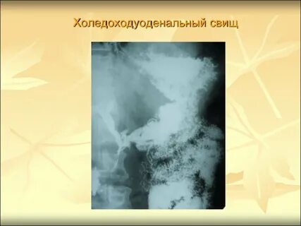 Желчные свищи
