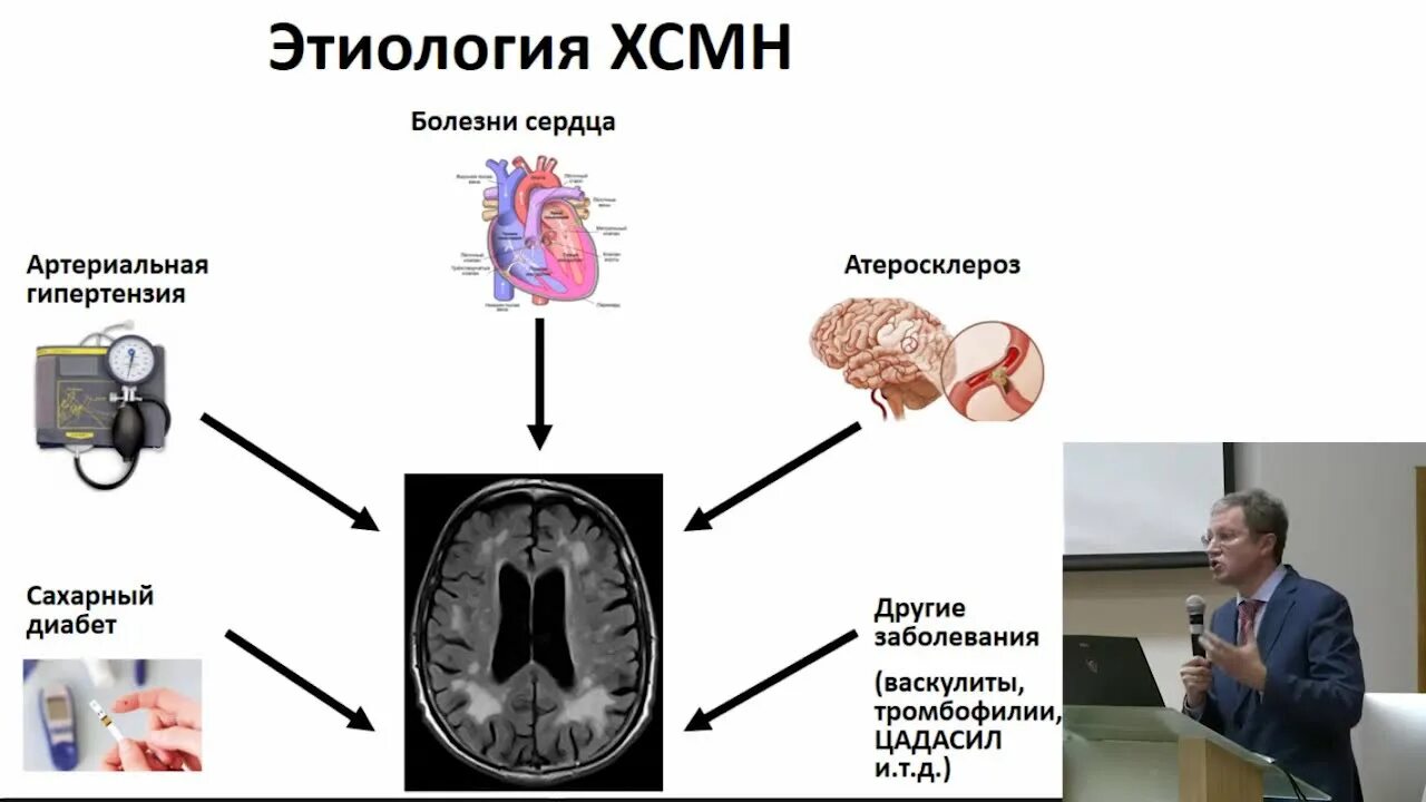 Как лечить ишемию мозга. Хроническая ишемия головного мозга. Степени ишемии головного мозга. Хроническая ишемия головного мозга этиология. Хроническая ишемия мозга мрт.