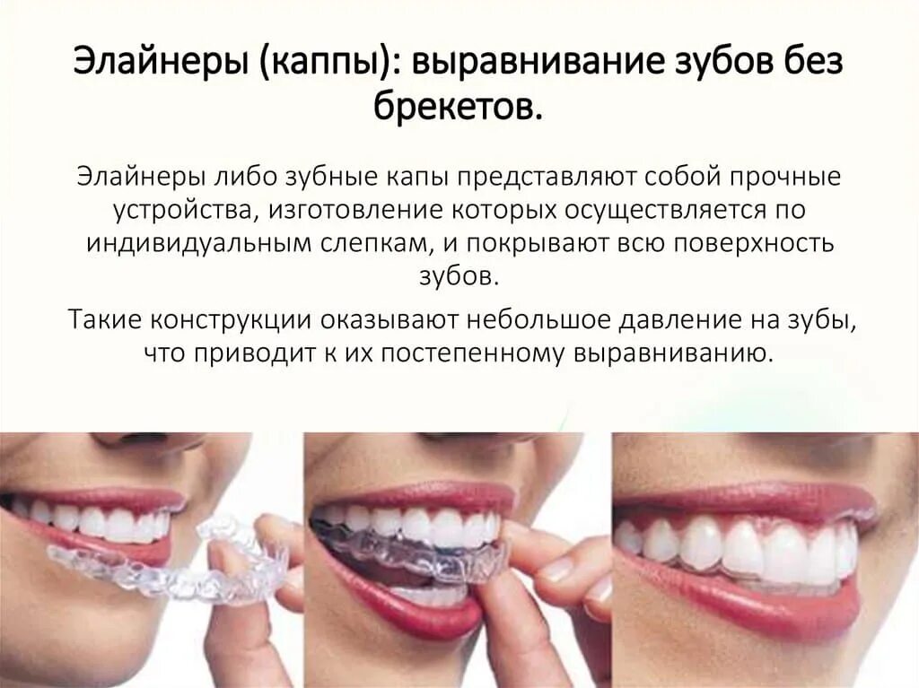 Элайнеры это. Выравнивание зубов элайнерами. элайнеры для выравнивания зубов. лайнер для зубов выравнивания. элайнеры для выравнивания.