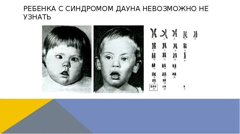 Синдром Дауна. Дети при синдром Дауна. Дети с синдромом Дауна презентация. Синдром Дауна презентация. Варианты синдрома дауна