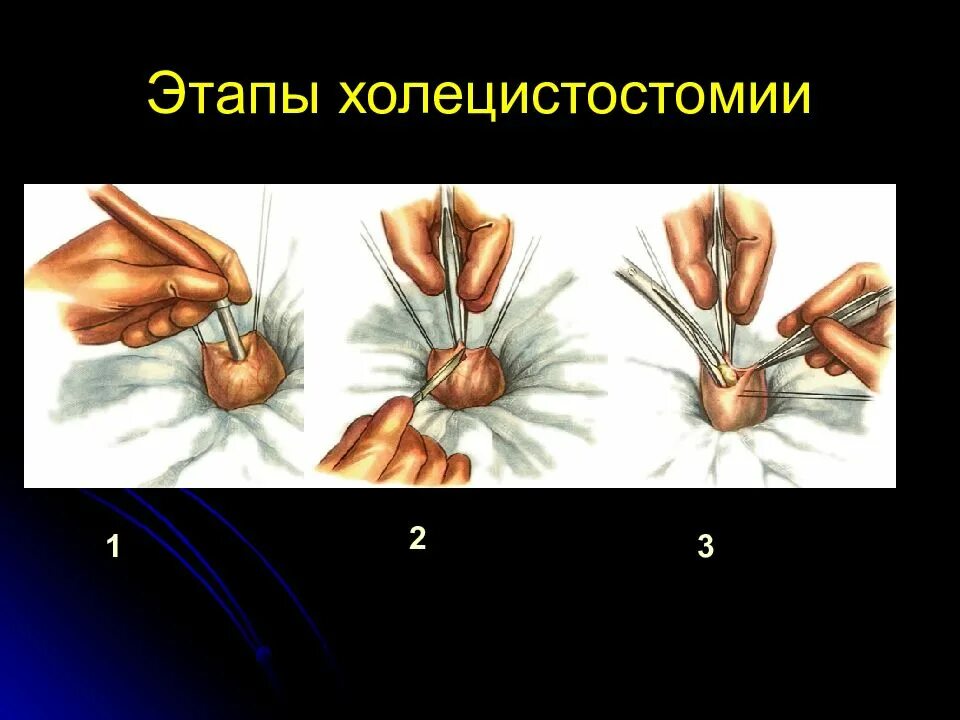 Холецистит дренаж