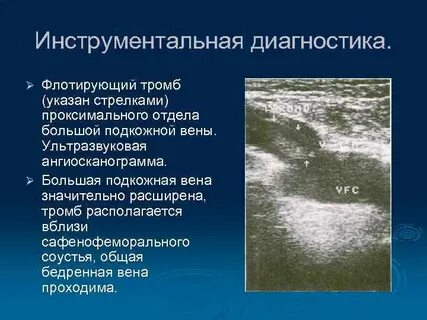 Флотирующий тромб