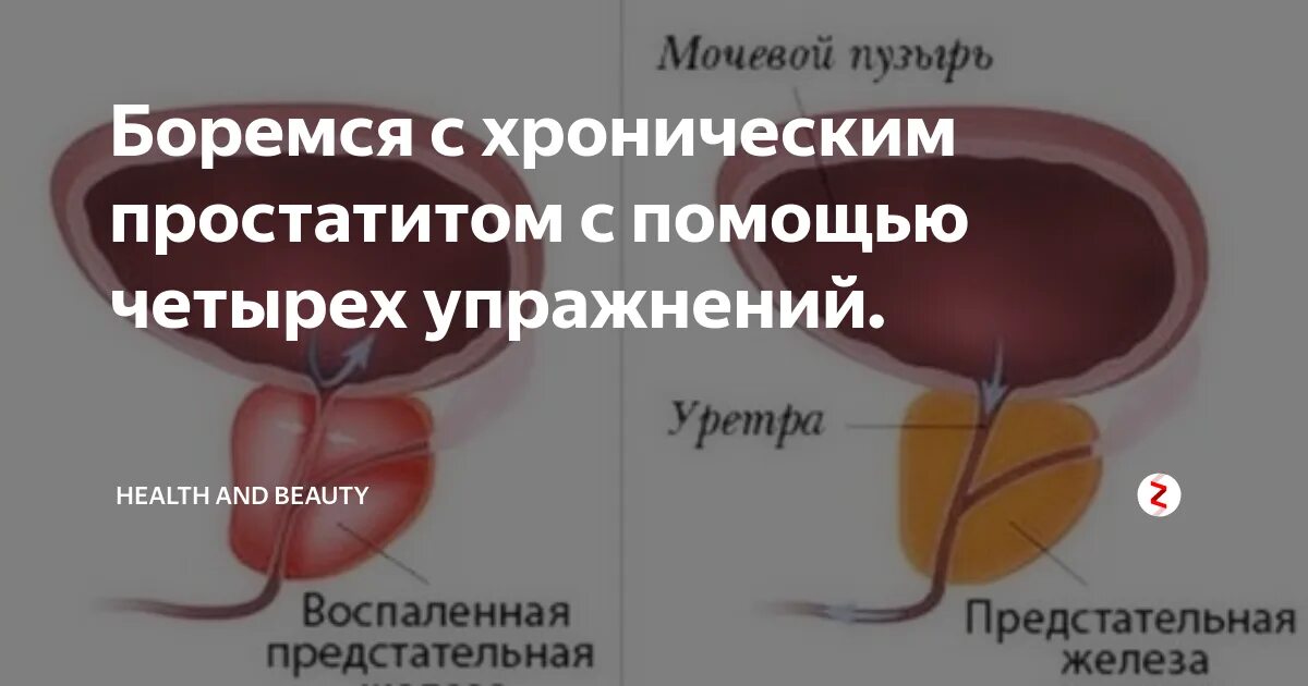 Удаляют ли предстательную железу