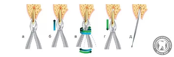 Хирургические инструменты для верхней челюсти. Зубы удалять щипцами. Щипцы зубного врача. Этапы удаления зубов верхней челюсти в стоматологии. Хирургия стоматология.