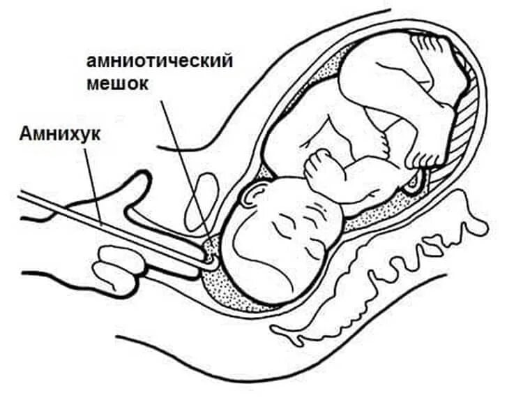 После прокола пузыря через сколько роды. Амниотомия (вскрытие плодного пузыря). Инструмент для прокола плодного пузыря. Как происходит вскрытие плодного пузыря. Прокол пузыря амниотомия плодного.