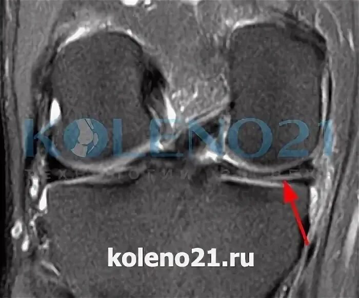 Разрыв медиального мениска мрт. Мрт разрыв заднего рога мениска. Горизонтальный разрыв мениска мрт. Разрыв заднего рога медиального мениска на мрт.