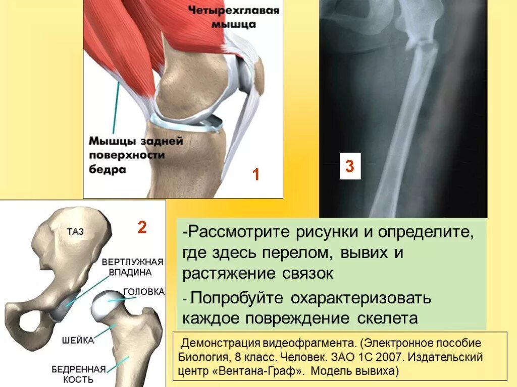 Поконкретней где. Перелом вывих растяжение отличие. Перелом вывих растяжение. Перелом бедра и вывих бедра.