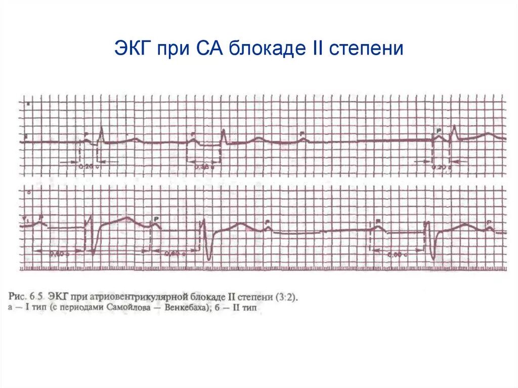 Са блокада 2 тип. Сино-атриальная блокада 2 степень ЭКГ. Синоатриальная блокада 1 степени на ЭКГ. Синоатриальная блокада 2 степени на ЭКГ. Са-блокада II степени, Тип i.