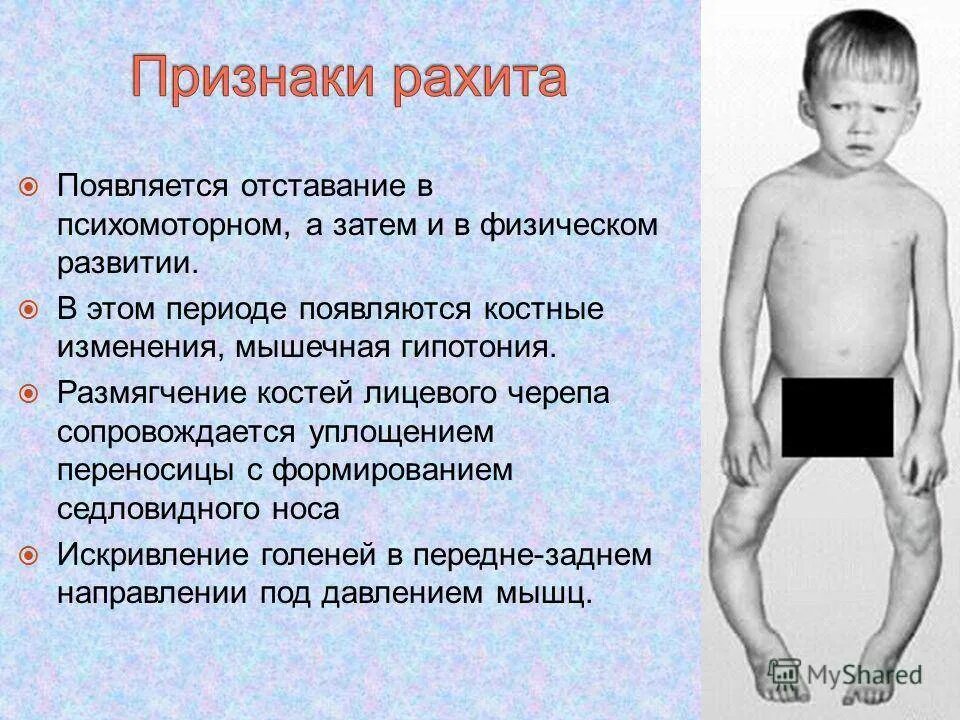 Хондродистрофия, рахит. Детский рахит симптомы. Острый рахит