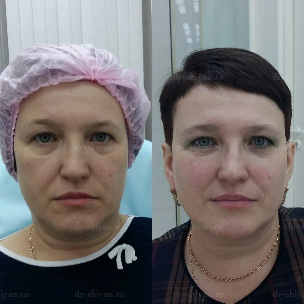 Изящный результат бьютификации лица от пластического хирурга Артура Александрови
