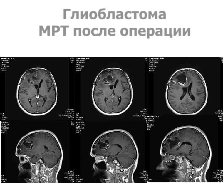 Мультиформная глиобластома. Глиобластома головного мозга мрт. Мультифокальная глиобластома кт.