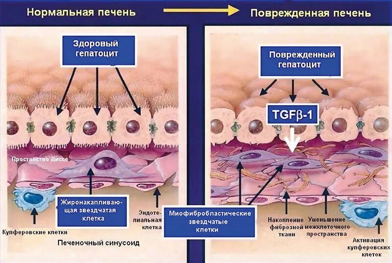 Механизм развития фиброза печени. Патогенез фиброза печени. Разрушение клеток печени. Регенерация клеток печени.