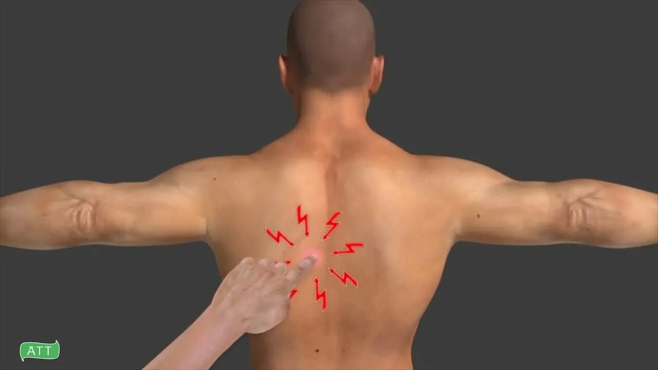 5 ударов между лопатками. Мышцы спины человека триггерные точки. Тт1 триггерная точка. Триггерные точки на теле человека на спине. Триггеры на спине под лопаткой.