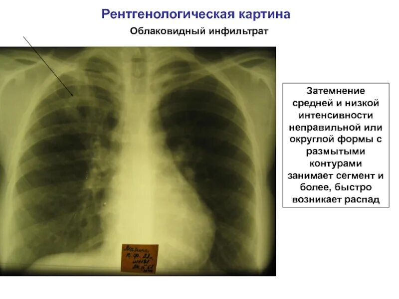 Округлое затемнение. Инфильтрат на рентгене легких. Облаковидный инфильтрат рентгенограмма. Облаковидный инфильтративный туберкулез. Туберкулез легкого затемнение.