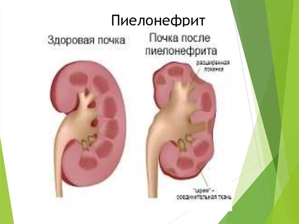 Почки после пиелонефрита. Здоровая почка и пиелонефрит.