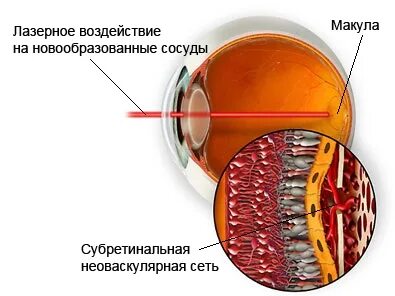 Дегенерация макулы и заднего полюса что это